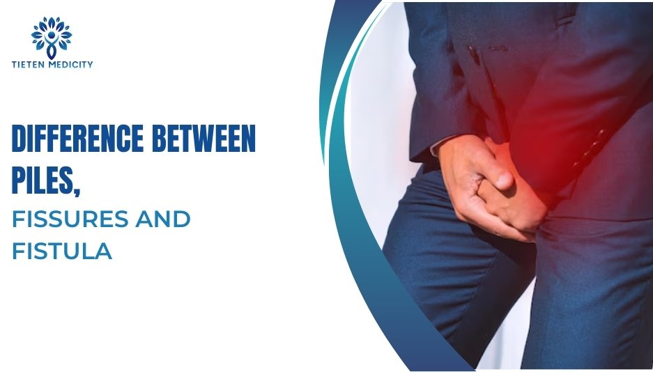 Difference Between Piles, Fissures and Fistula